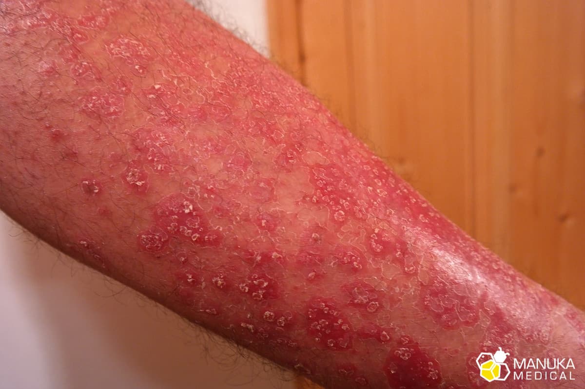 Nie drap ! Jak złagodzić objawy egzemy i problemy skórne